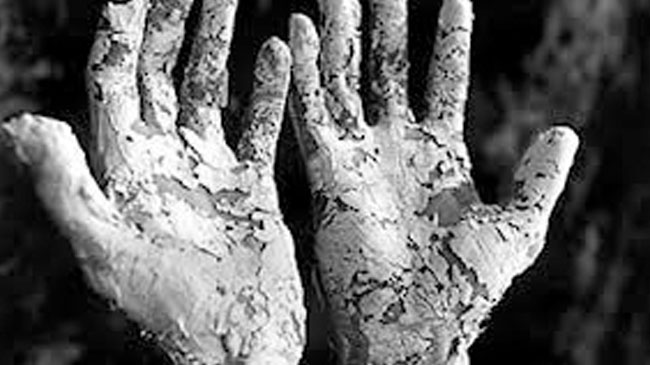 Cüzzam hastalığının tedavisi ücretsiz